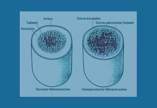 Unterschied zwischen osteoporotischem und normalem Knochengewebe.