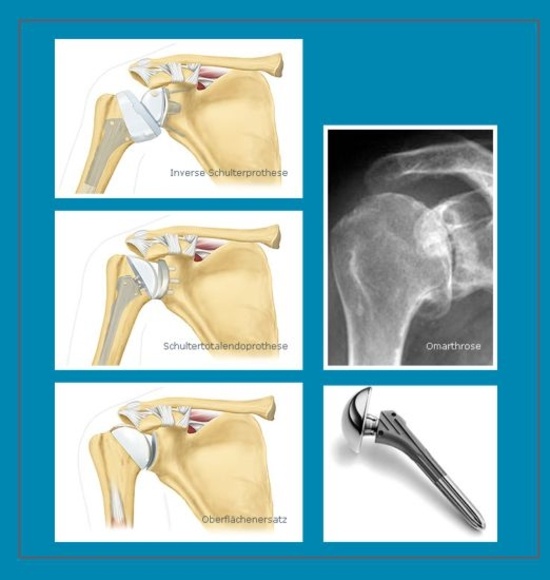 Die Schulterprothese