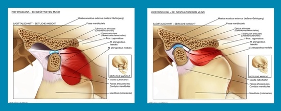 Das Kiefergelenk in geschlossenem und geöffnetem Zustand, jeweils von seitlich betrachtet. Die Verformungen der Gelenkzwischenscheibe aus Knorpel lassen die Beanspruchung des Gelenks beim Kauen oder Beißen erahnen.(Bildquelle: Univadis)
