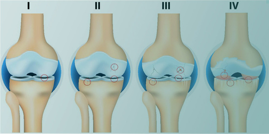 Entwicklung einer Kniegelenksarthrose