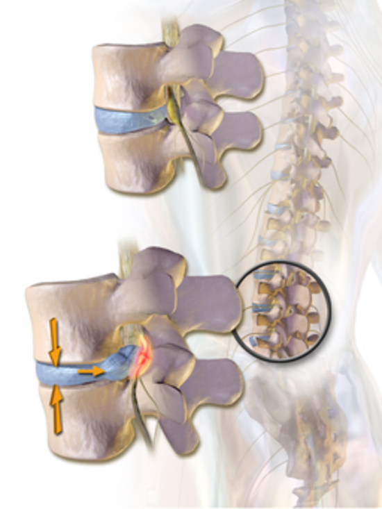 Herniated Disc