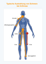 Schmerzausstrahlung bei Arthrose