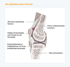 Die patellofemorale Arthrose (PFA)