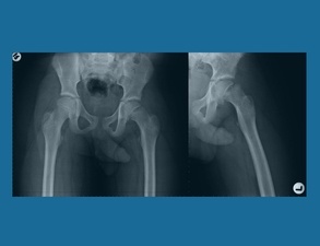 Epiphysiolyse mit Abrutschen des Hüftkopfes Epiphysiolyse mit Abrutschen des Hüftkopfes