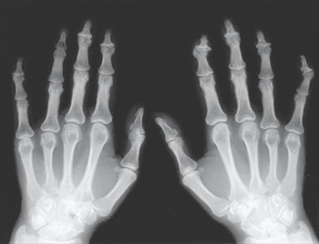 Arthrose der Fingergelenke (UK School of Radiology) Arthrose der Fingergelenke (UK School of Radiology)