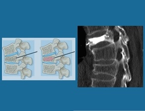 Schematische undradiologische Darstellung einer durchgeführten Vertebroplastie Schematische undradiologische Darstellung einer durchgeführten Vertebroplastie